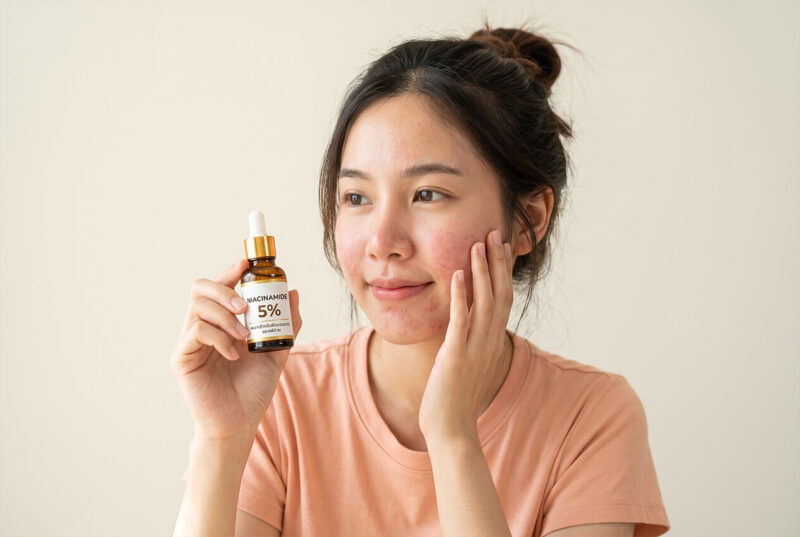 Niacinamide ความเข้มข้นสูงกับผิวแพ้ง่าย